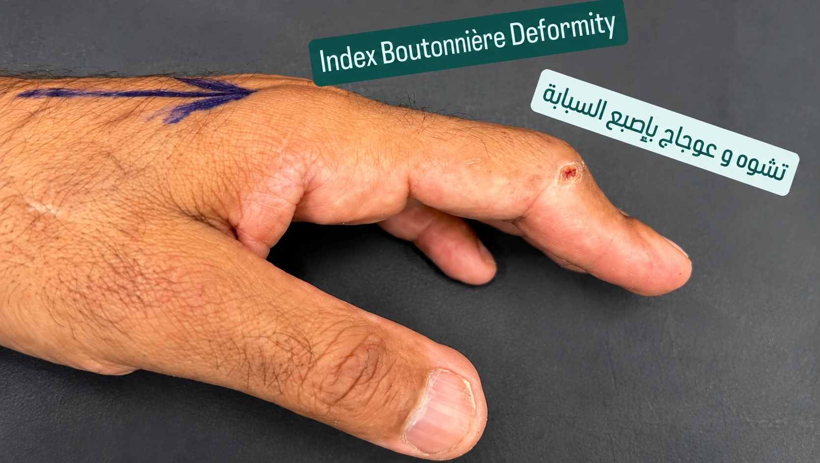 Annotated Index Finger Deformity result