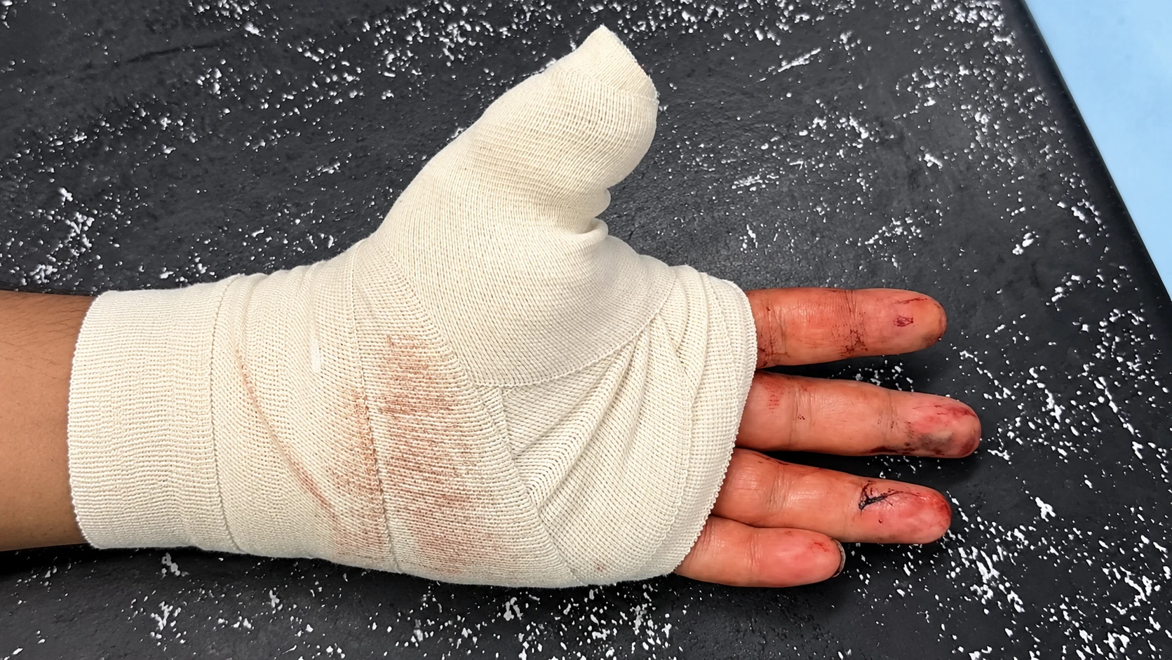 Bandaged Hand on Speckled Table result