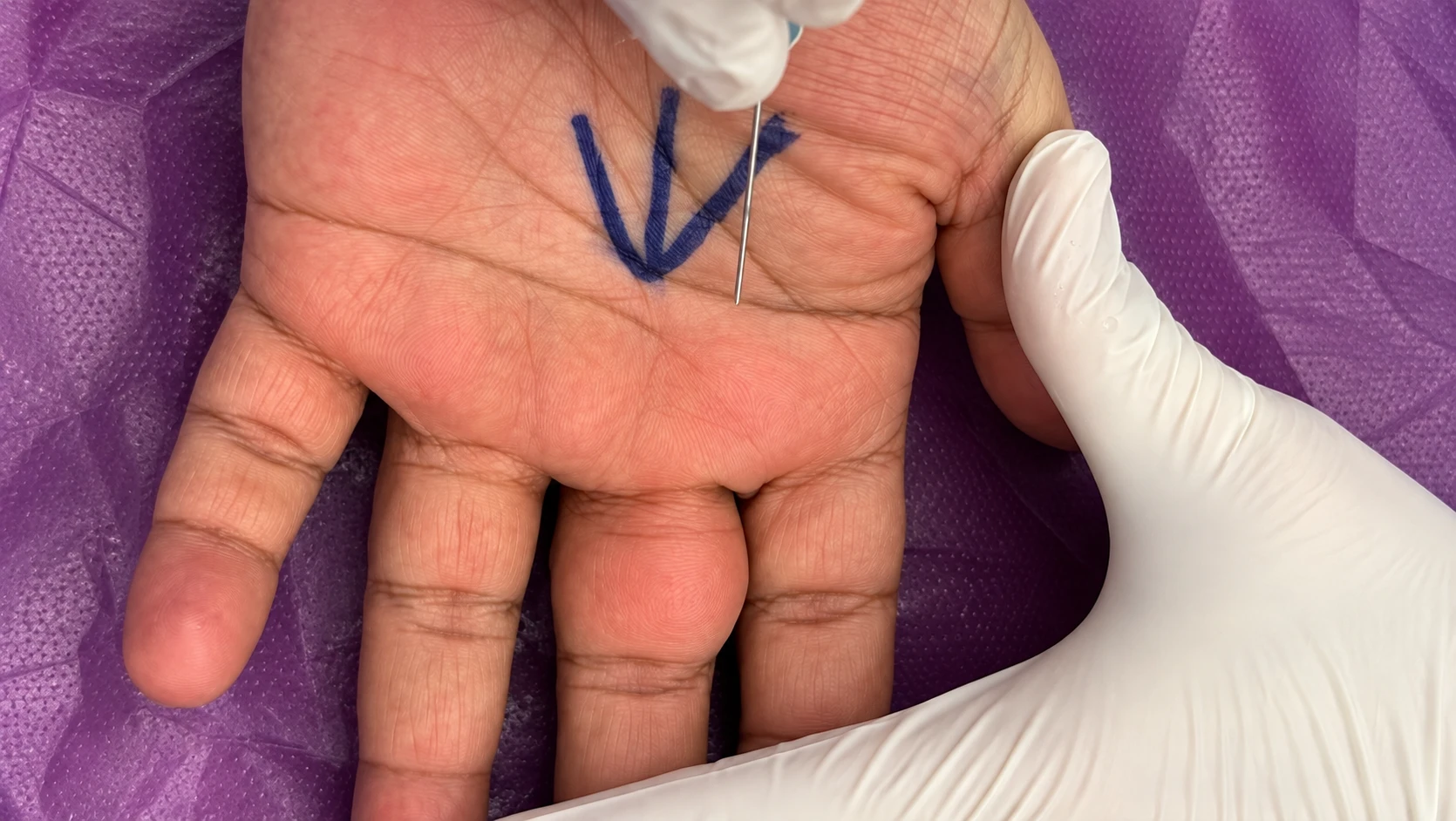 Clinical Palm Marking with Needle result