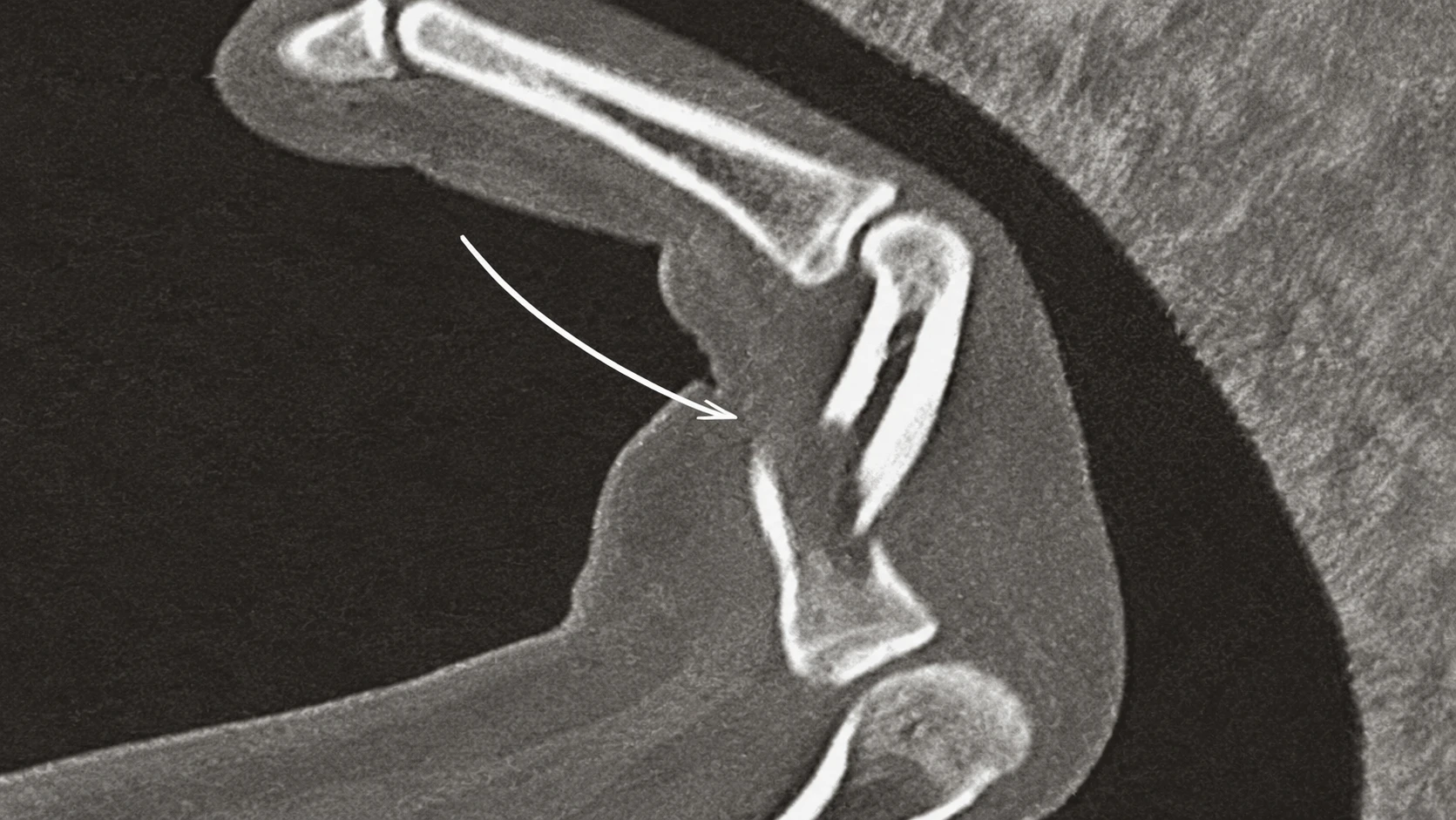 Sagittal CT Elbow Scan with Arrow result