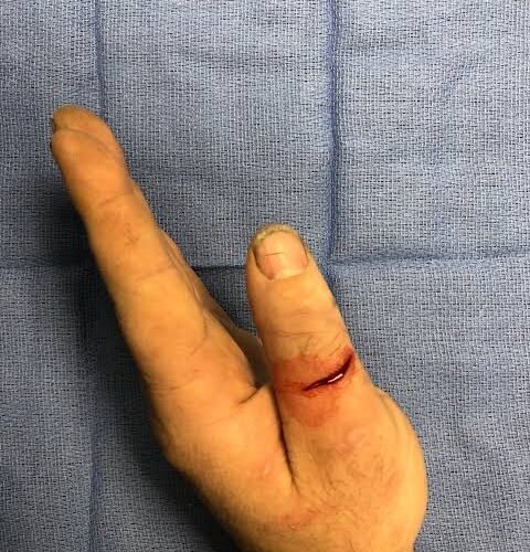 Cut tendons 4 480x500