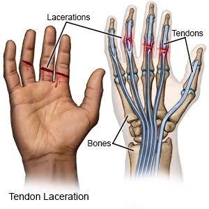 Cut tendons 5