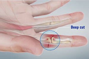 Cut tendons 6 e1782598325143
