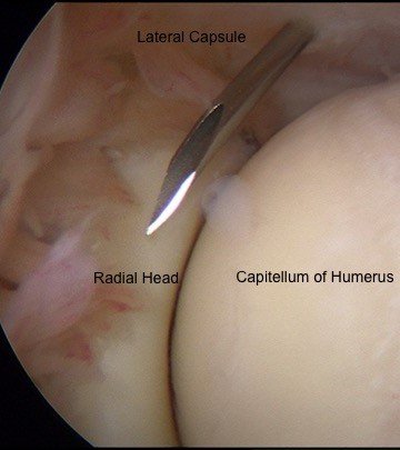 Elbow scope