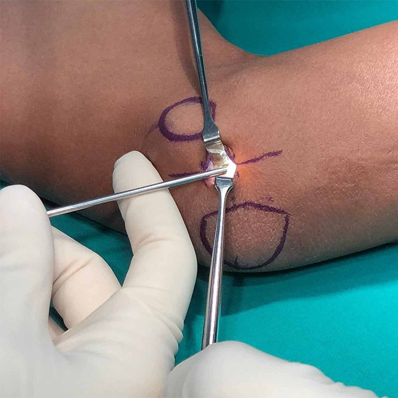 Tennis elbow surgical treatment
