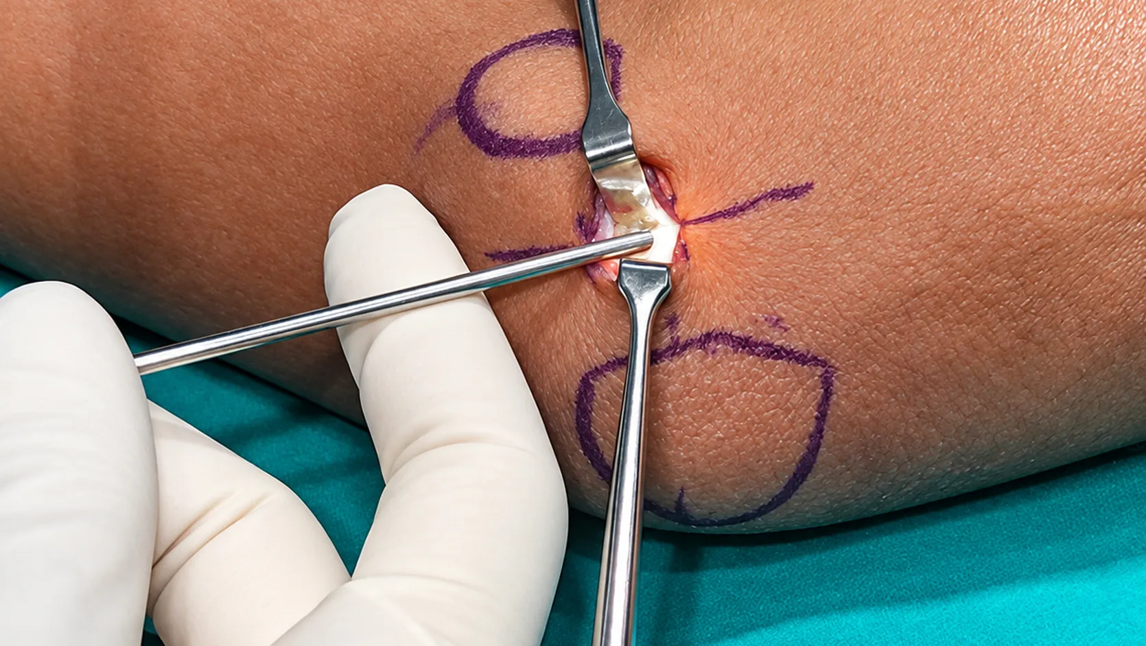 Tennis elbow surgery 1670x942 result