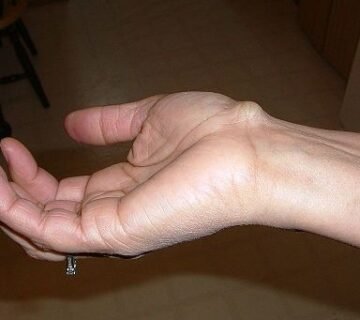 Ganglion Cyst dr mohamed abas elbishbishi 360x320