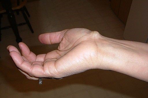 Ganglion Cyst dr mohamed abas elbishbishi