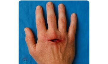 Cut tendons 2 e1782324739379