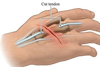 Cut tendons3 e1782324670495