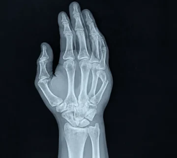 Detailed Hand X ray Radiograph result 360x320
