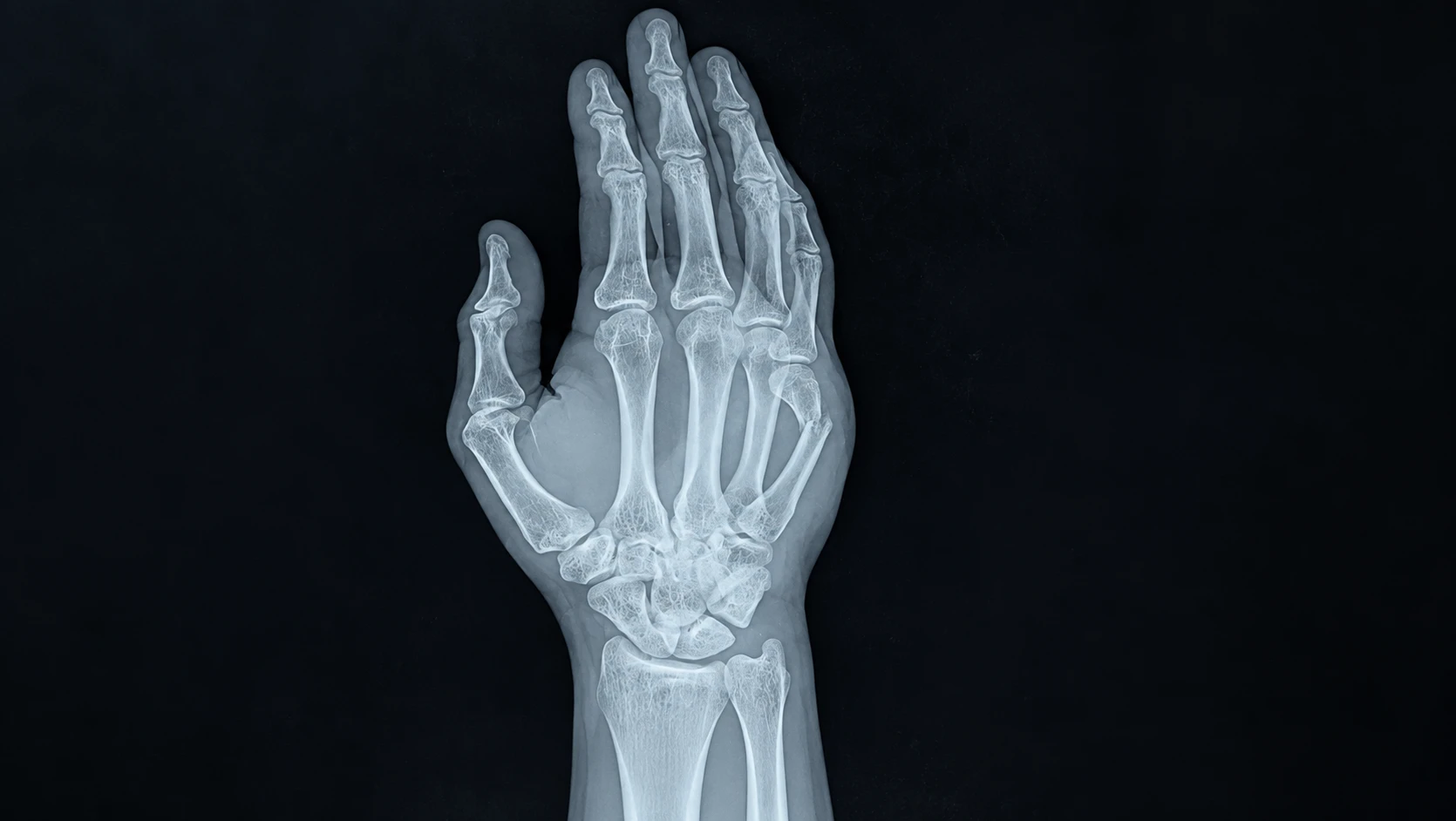 Detailed Hand X ray Radiograph result